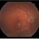 Hypertensive retinopathy Hypertensive retinopathy